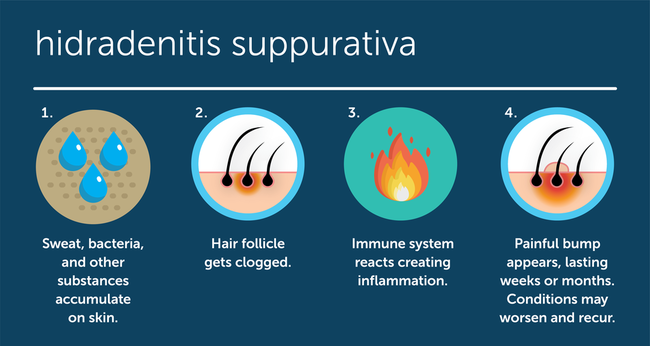 What is Hidradenitis Suppurativa (HS)?