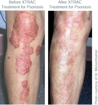 laser light therapy for psoriasis