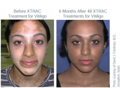 vitiligo light