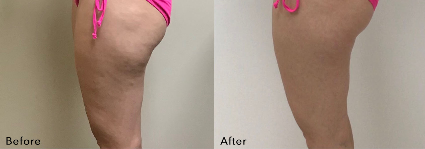 Exclusive Before & After Physiq Body Treatments